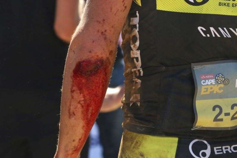 Kristian Hynek of Topeak Ergon Racing injured arm after a crash during stage 3 of the 2016 Absa Cape Epic Mountain Bike stage race held from Saronsberg Wine Estate in Tulbagh to the Cape Peninsula University of Technology in Wellington, South Africa on the 16th March 2016 Photo by Shaun Roy/Cape Epic/SPORTZPICS PLEASE ENSURE THE APPROPRIATE CREDIT IS GIVEN TO THE PHOTOGRAPHER AND SPORTZPICS ALONG WITH THE ABSA CAPE EPIC {ace2016}